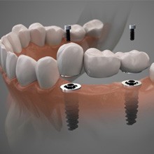 A 3D illustration of an implant bridge