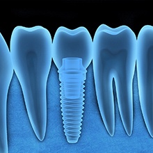 Diagram of an X-ray taken showing an integrated dental implant