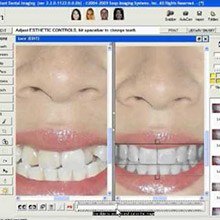 Virtual smile design software on computer