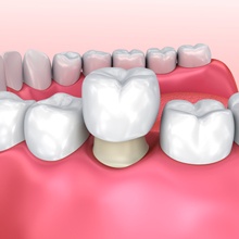 3D image of a crown being put on a tooth