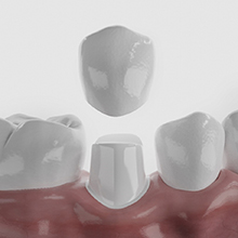 Illustration of porcelain or ceramic dental crown being placed on tooth