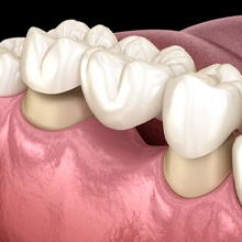 diagram of dental bridge being placed in person’s mouth