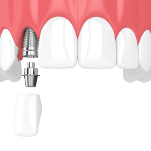 dental implants being placed in the upper jaw