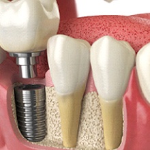 dental implant being placed in the lower jaw