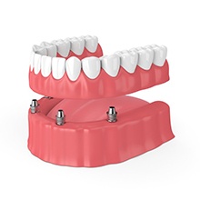 implant-retained full denture on bottom arch 