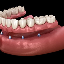 Digital model of an implant denture