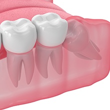 impacted tooth illustration for cost of tooth extraction Virginia Beach