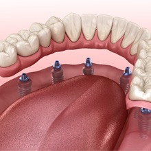 A 3D illustration of an implant denture