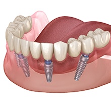 Diagram breaking down implant dentures in Virginia Beach