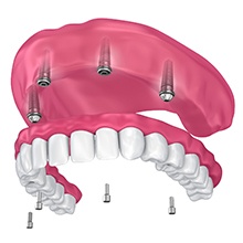 Diagram showing how implant dentures in Virginia Beach work
