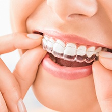 Invisalign trays are more discreet than traditional braces