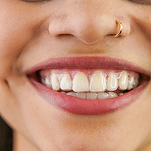 Invisalign aligners are more comfortable than traditional braces