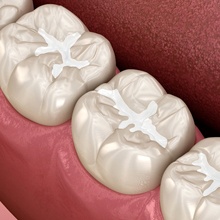 3D illustration of tooth-colored fillings