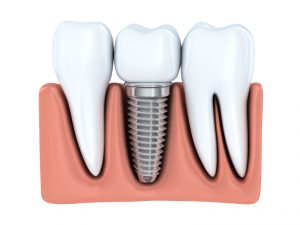 Learn more about the benefits of dental implants in Virginia Beach.