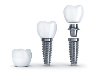 Smile by Design helps patients overcome their dental fears by explaining the “ins and outs” of a dental implant in Virginia Beach, VA. 