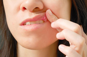 What To Do When Canker Sores Won T Go Away Smile By Design Virginia Beach Family Dentistry Blog