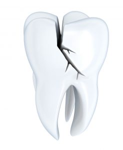 cracked tooth dental damage