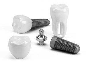 dental implants