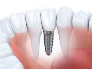 Dental implants.