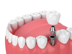 dental implants illustration