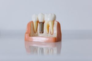 Model of a dental implant
