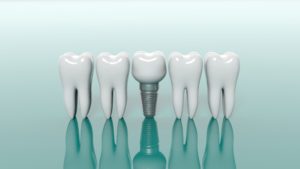 Dental implant for missing back tooth