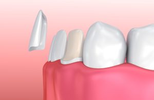 Model of dental veneer on lower tooth