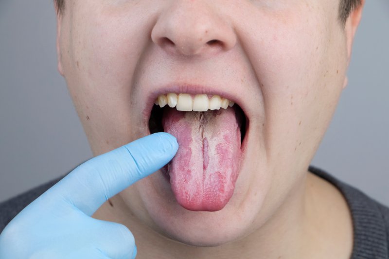 A person pointing to a white film in their mouth