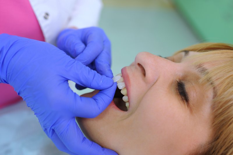 A dentist placing a patient’s dental veneers