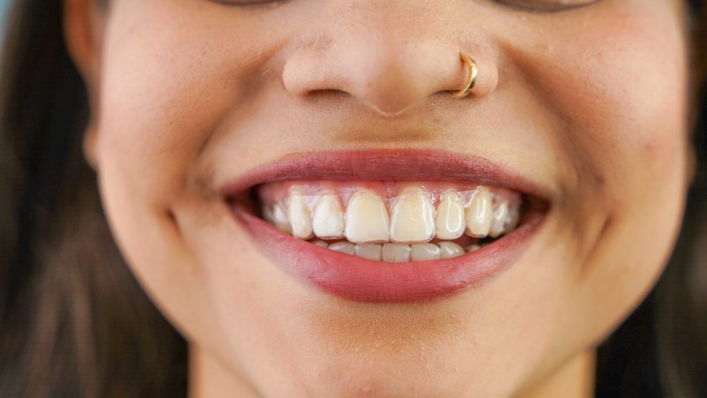 Closeup of woman with clear aligners smiling