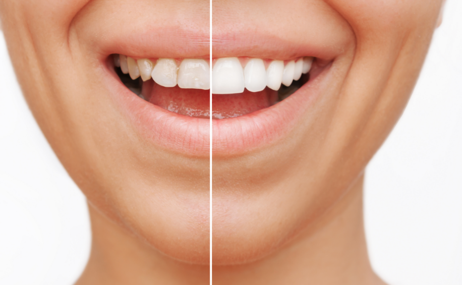 Woman's smile with half veneers, half natural teeth.